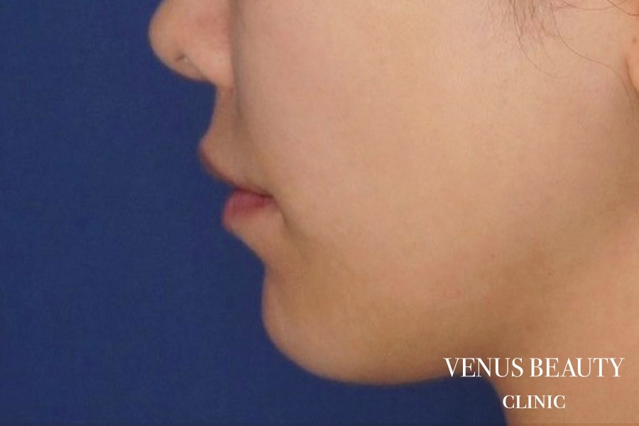 人中短縮術 施術前