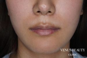 人中短縮術 施術前