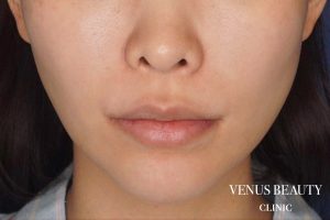 人中短縮術 施術前