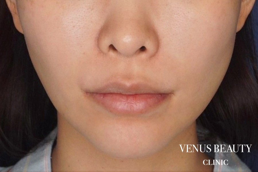 人中短縮術 施術前