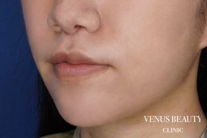 M字リップ形成 施術後