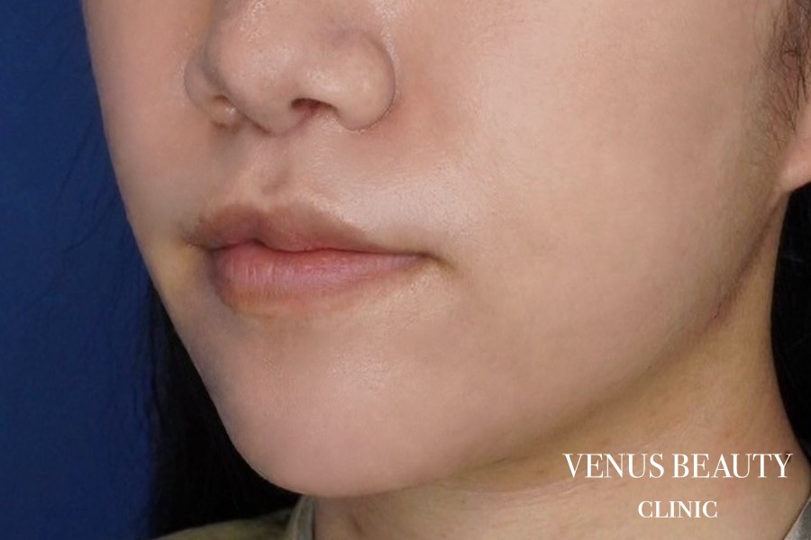 M字リップ形成 施術後