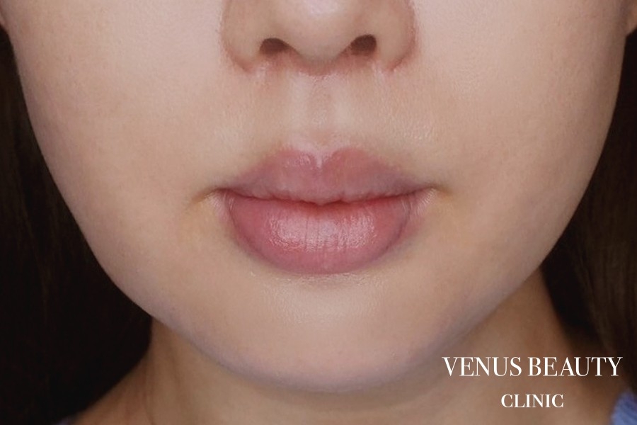 人中短縮術 施術後