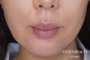 人中短縮術 施術前