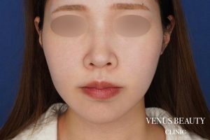 糸リフト＋脂肪吸引 施術後