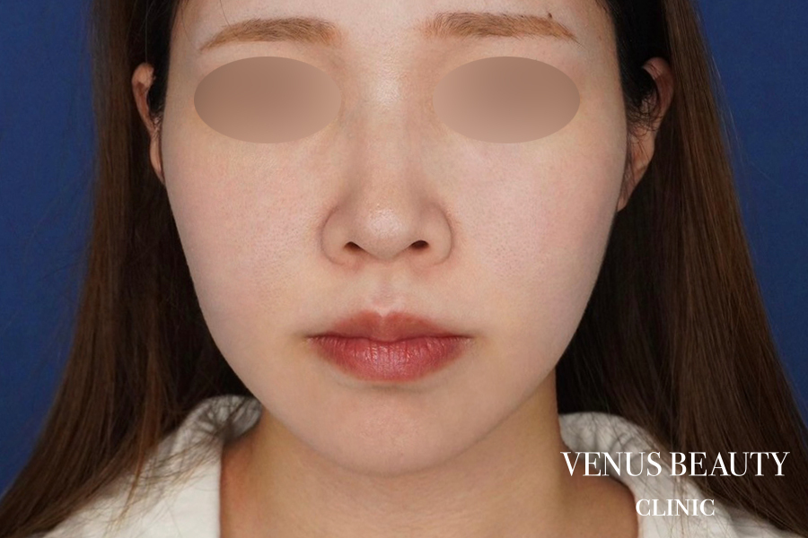 糸リフト＋脂肪吸引 施術後