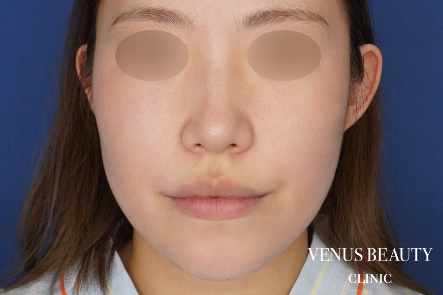 糸リフト＋脂肪吸引 施術前