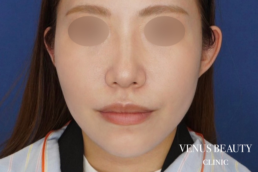 糸リフト＋脂肪吸引 施術後