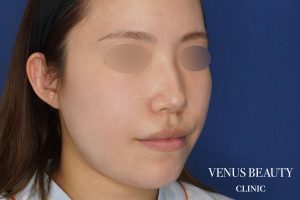 糸リフト＋脂肪吸引 施術前