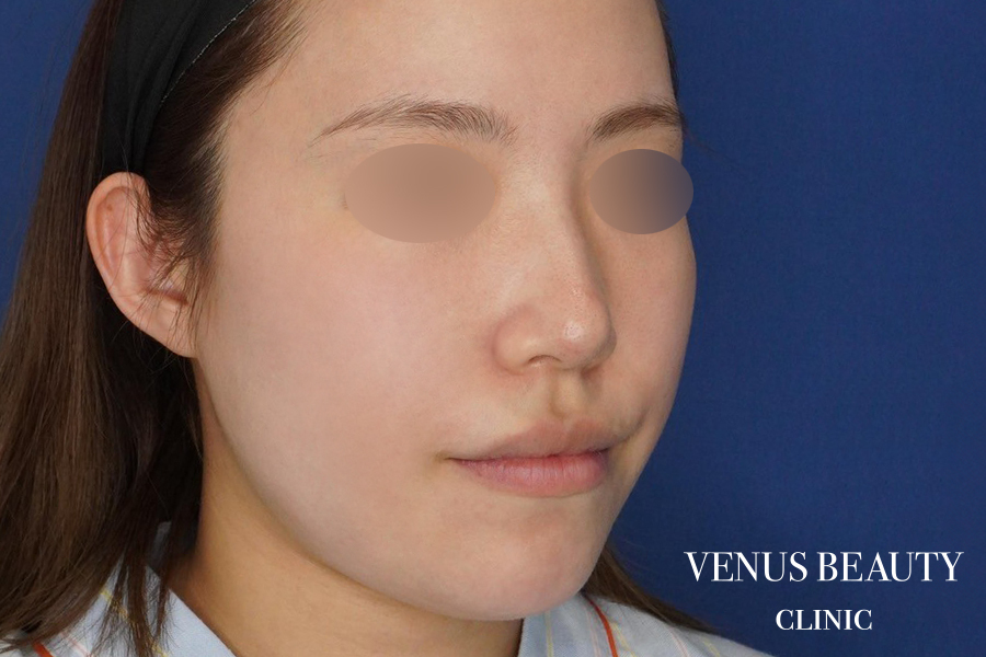 糸リフト＋脂肪吸引 施術前