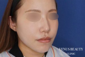 糸リフト＋脂肪吸引 施術後