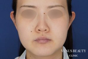 糸リフト＋脂肪吸引 施術前