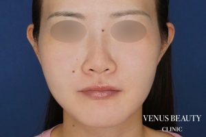 糸リフト＋脂肪吸引 施術後