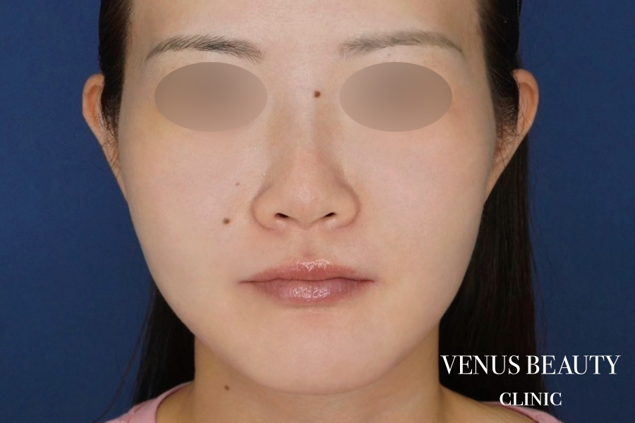 糸リフト＋脂肪吸引 施術後