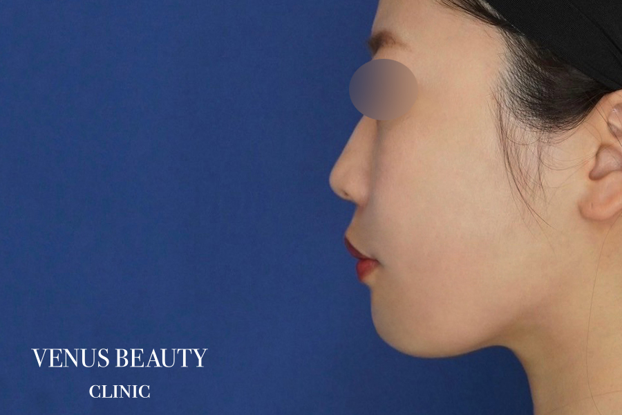 糸リフト＋脂肪吸引 施術後