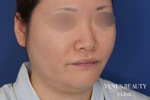 糸リフト＋脂肪吸引 施術前