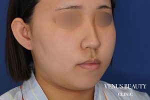 糸リフト＋脂肪吸引 施術前