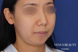 糸リフト＋脂肪吸引 施術前