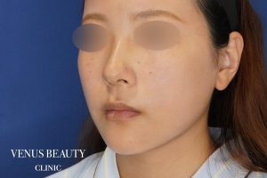 糸リフト＋脂肪吸引 施術後