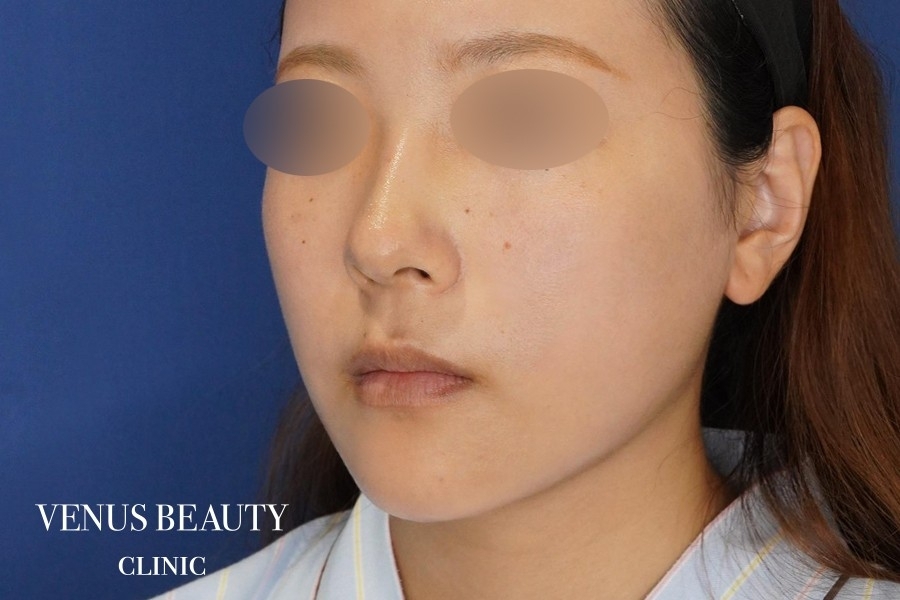 糸リフト＋脂肪吸引 施術後