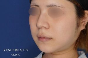 糸リフト＋脂肪吸引 施術前