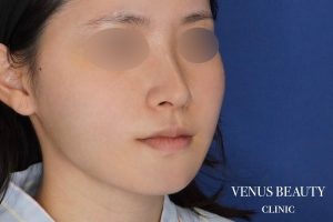 糸リフト＋脂肪吸引 施術後