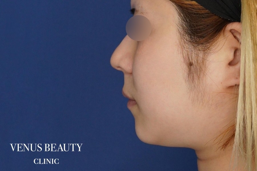 糸リフト＋脂肪吸引 施術前