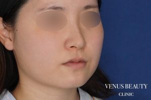 糸リフト＋脂肪吸引 施術前