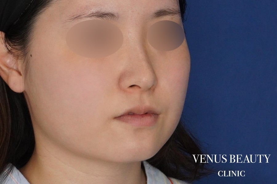 糸リフト＋脂肪吸引 施術前