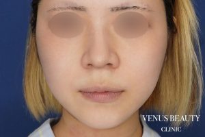 糸リフト＋脂肪吸引 施術前