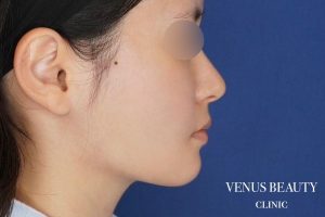 糸リフト＋脂肪吸引 施術後