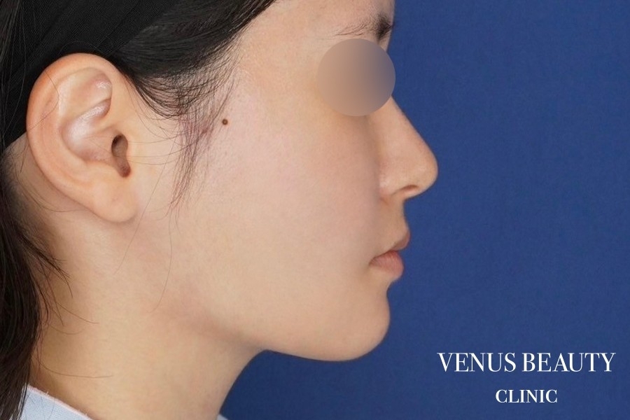 糸リフト＋脂肪吸引 施術後