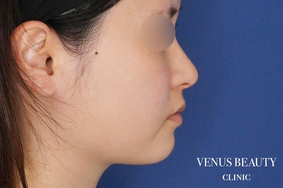 糸リフト＋脂肪吸引 施術前