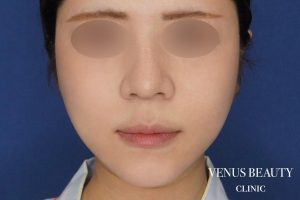 糸リフト＋脂肪吸引 施術後