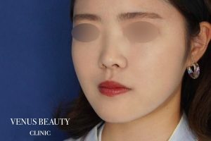 糸リフト＋脂肪吸引 施術後