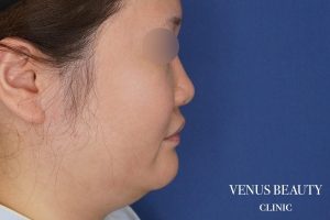 糸リフト＋脂肪吸引 施術前