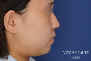 糸リフト＋脂肪吸引 施術前