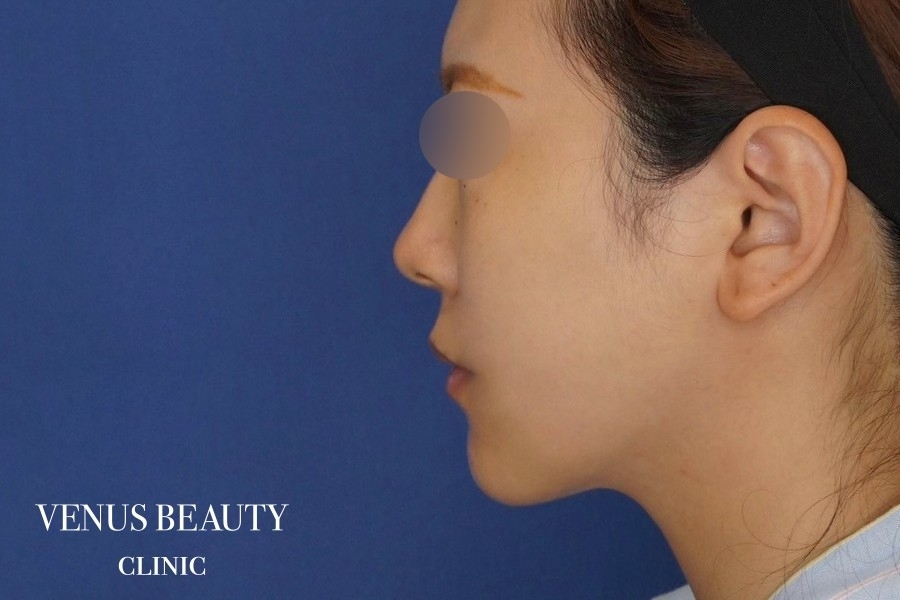 糸リフト＋脂肪吸引 施術後