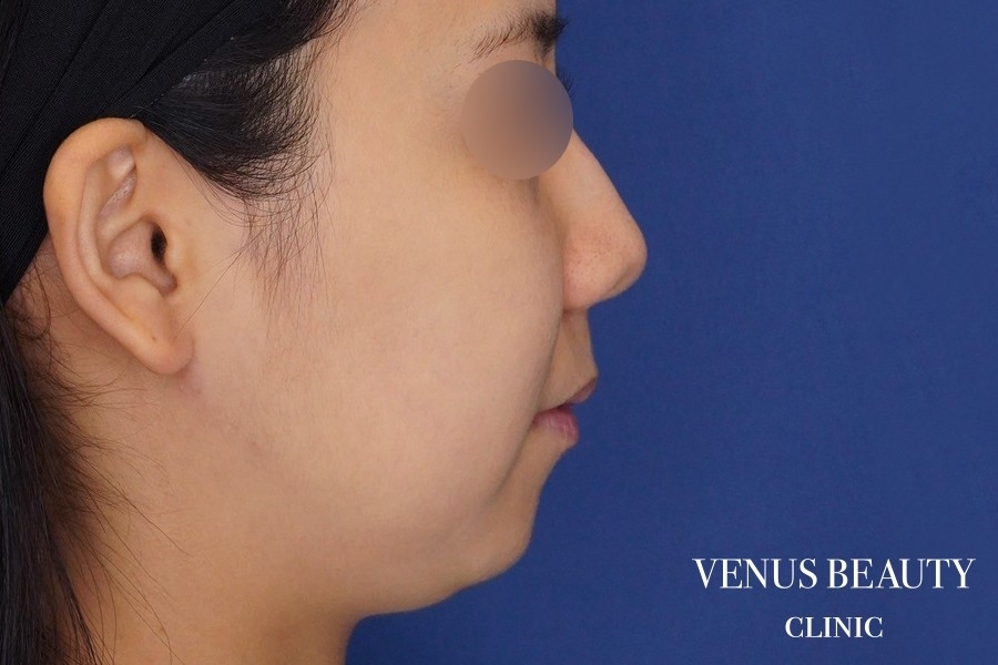 糸リフト＋脂肪吸引 施術前