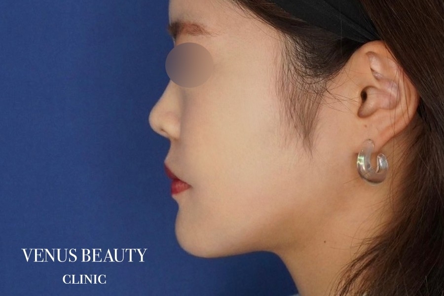 糸リフト＋脂肪吸引 施術後