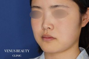 糸リフト＋脂肪吸引 施術前