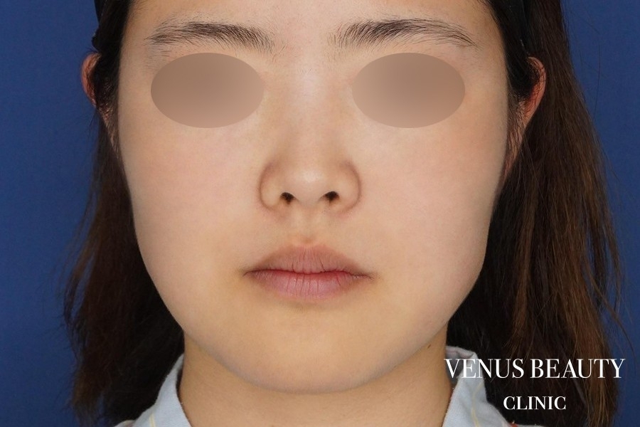 糸リフト＋脂肪吸引 施術前