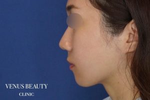 糸リフト＋脂肪吸引 施術後