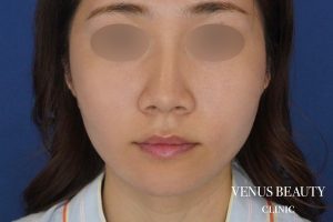 糸リフト＋脂肪吸引 施術後