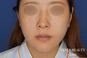 糸リフト＋脂肪吸引 施術後