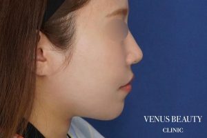 糸リフト＋脂肪吸引 施術後