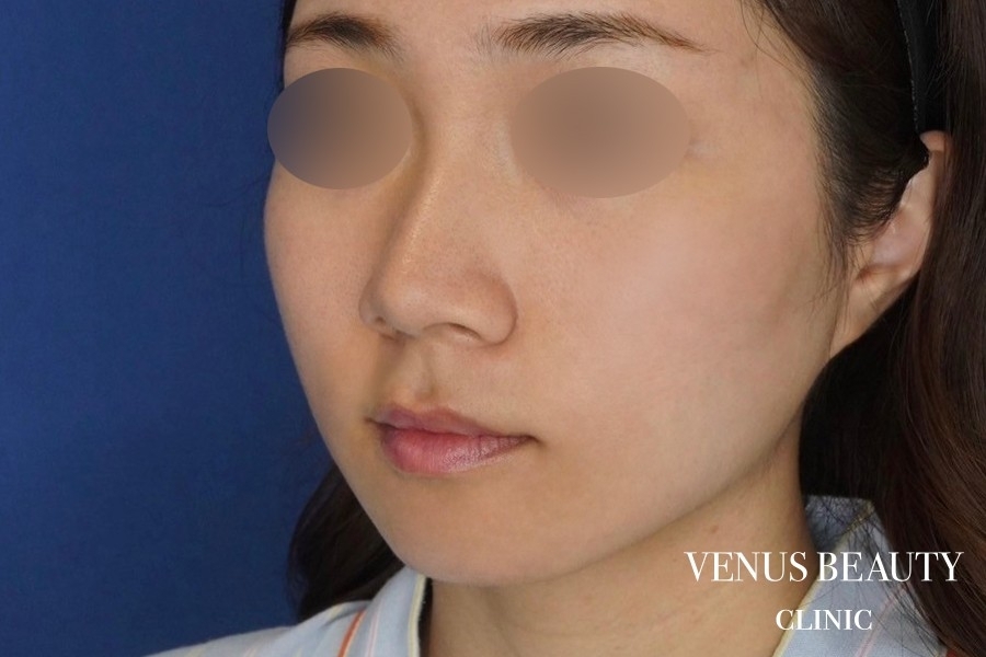 糸リフト＋脂肪吸引 施術後