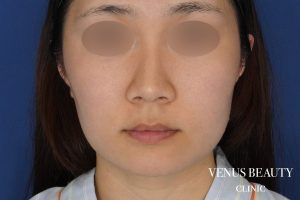 糸リフト＋脂肪吸引 施術前