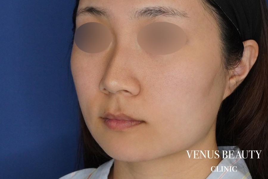 糸リフト＋脂肪吸引 施術前