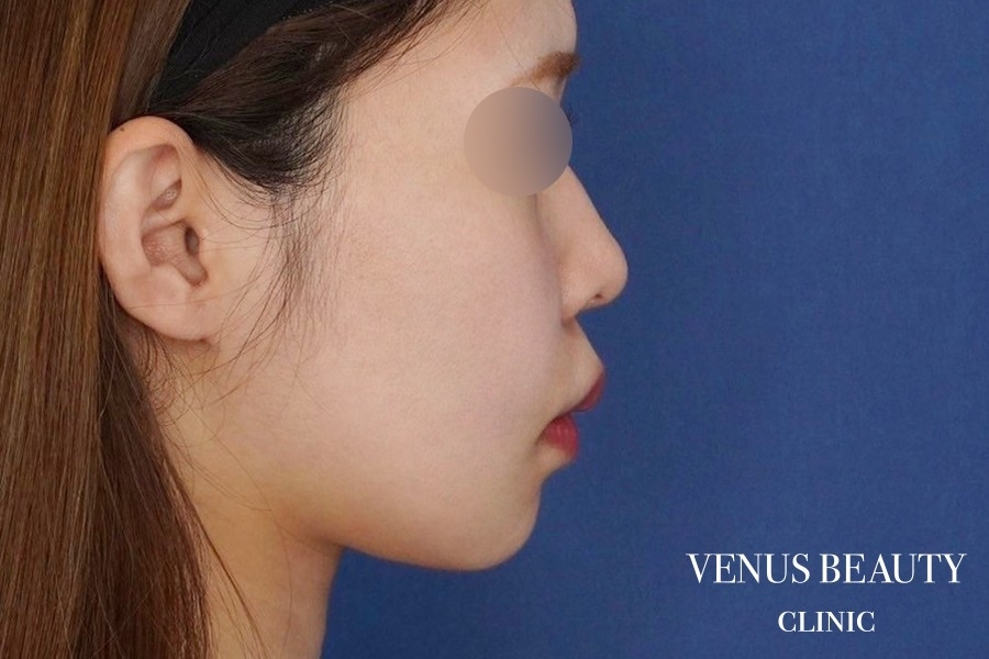 糸リフト＋脂肪吸引 施術後